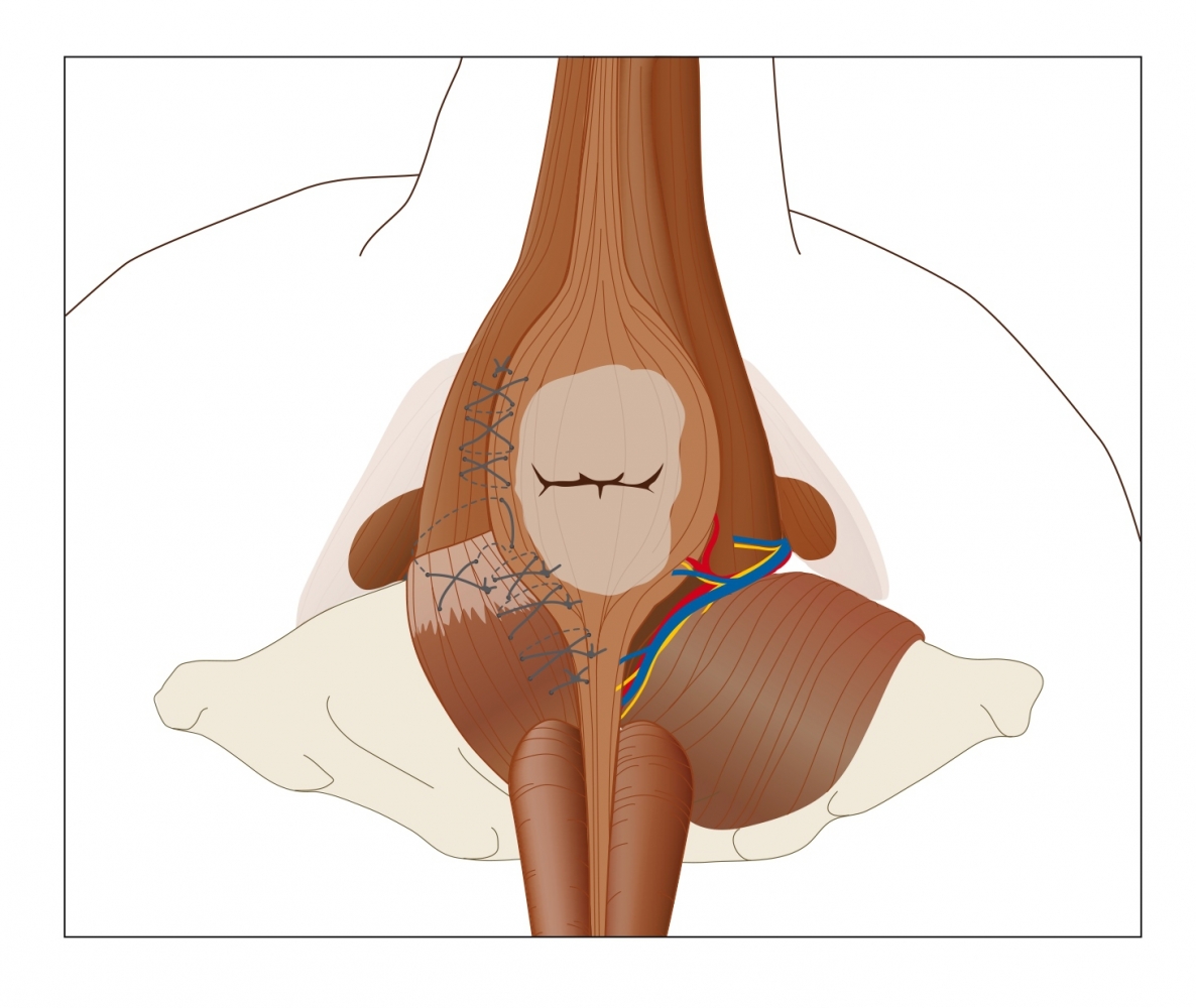 behandeling hernia perinealis